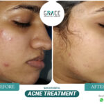 Before and After Image of Acne Treatment