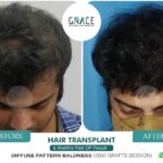 Before After Image of our Patient underwent Hair transplant