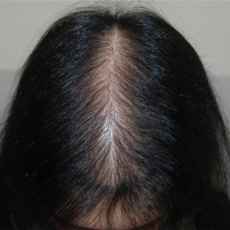 Androgenetic Alopecia (Male/ Female Pattern Baldness) In Detail