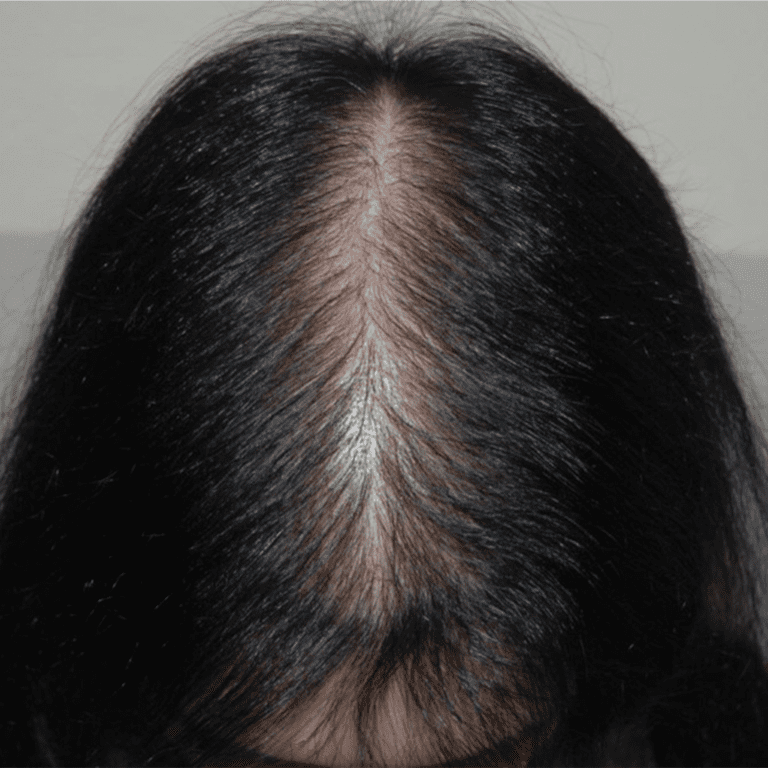 androgenetic-alopecia