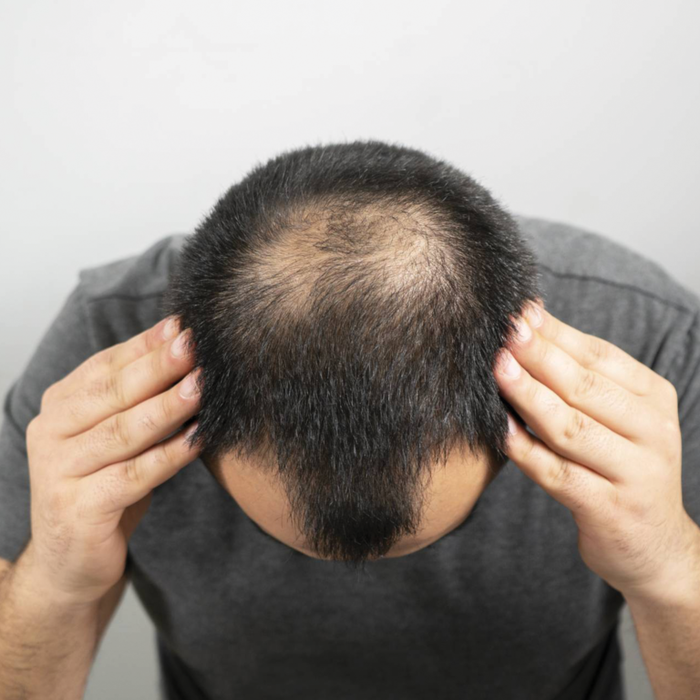 How To Regrow Hair Without Surgery