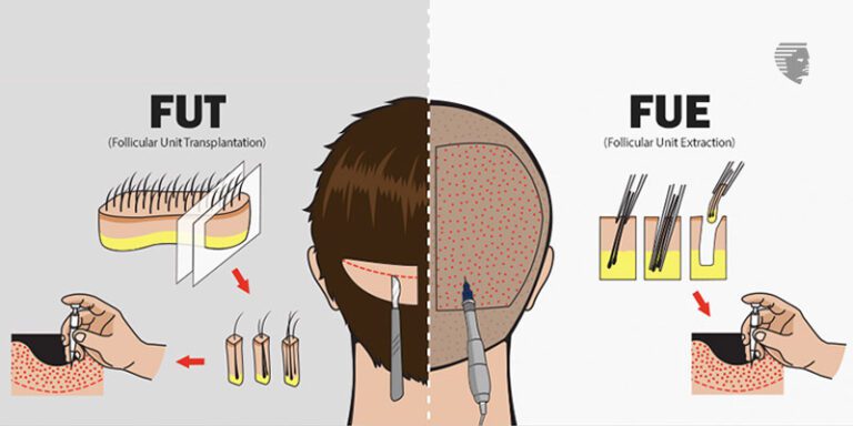 What are the Long term benefits of a Hair Transplant?