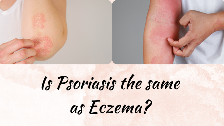 Is Psoriasis the same as Eczema?