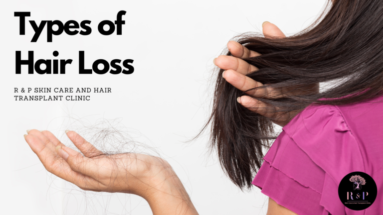 What are the types of Hair Loss?