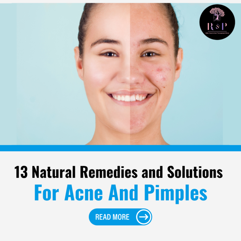 13 Natural Remedies and Solutions For Acne And Pimples