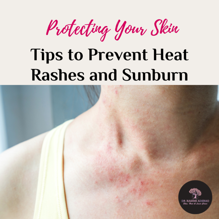 Protecting Your Skin: Tips to Prevent Heat Rashes and Sunburn