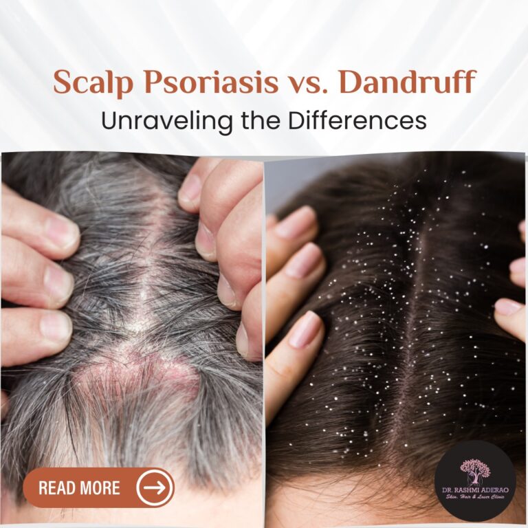 Scalp Psoriasis vs. Dandruff: Unraveling the Differences