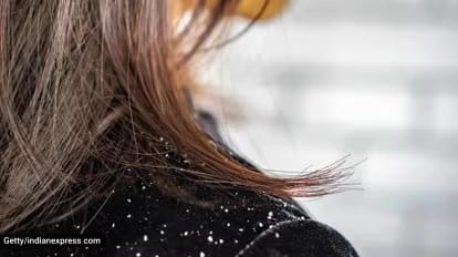 Anxiety, stress and its unlikely companion: Aggravated dandruff and scalp conditions