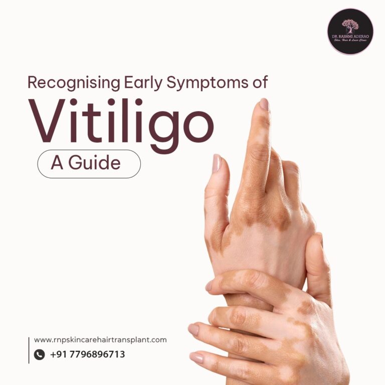 Recognizing Early Symptoms of Vitiligo: A Guide