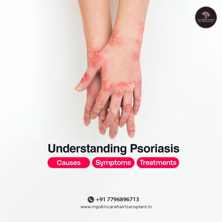 Understanding Psoriasis: Causes, Symptoms, and Treatment